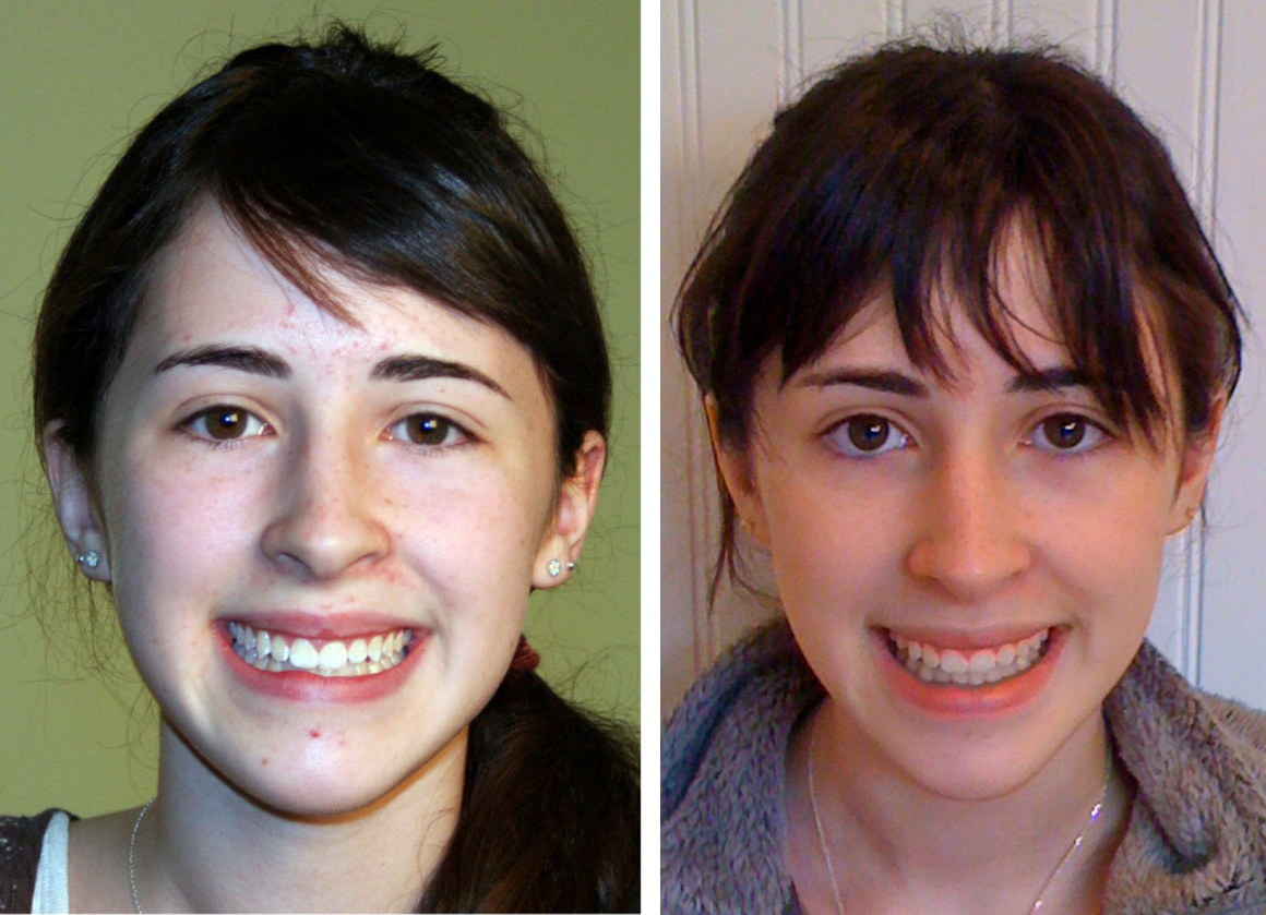 Как правильно поменяться. Асимметрия лица. Кривые зубы до и после брекетов.
