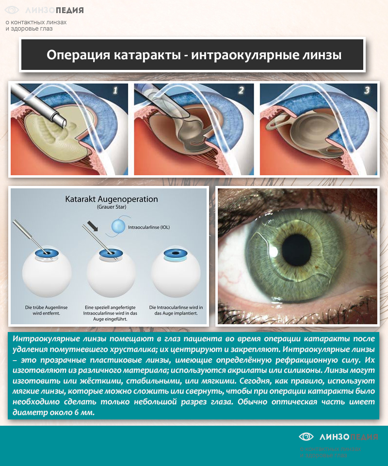 Катаракта глаза – симптомы, лечение и причины