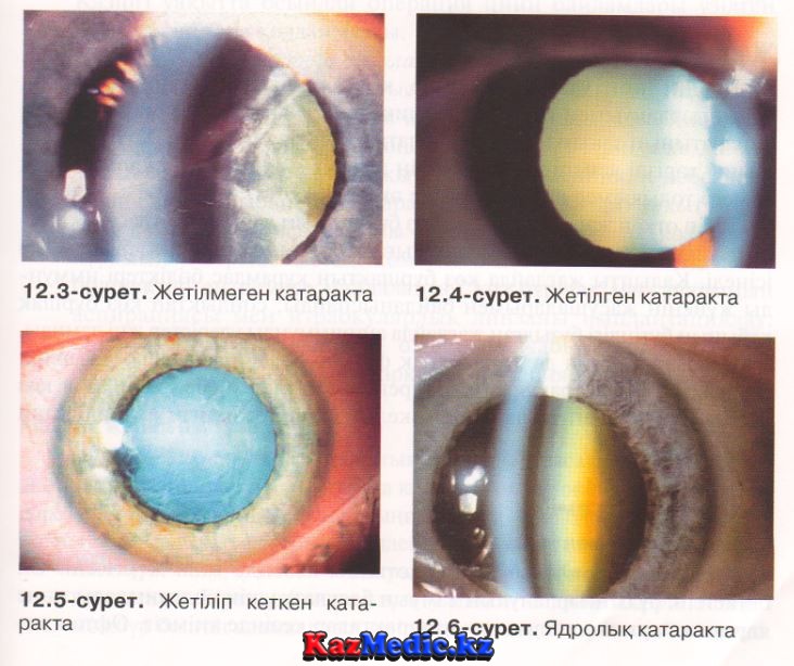 Начальная катаракта