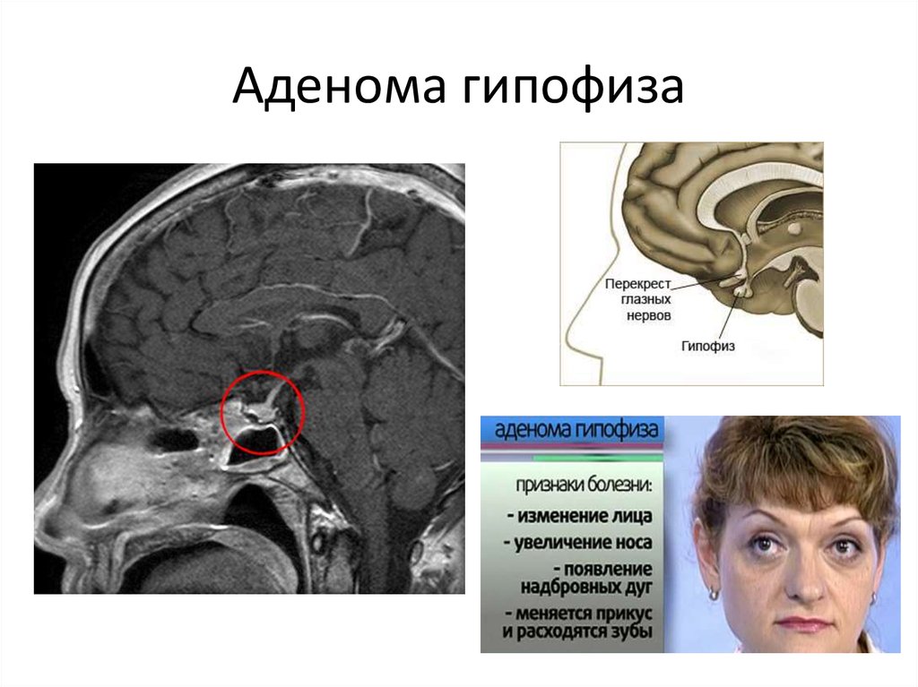 Аденома гипофиза головного мозга фото