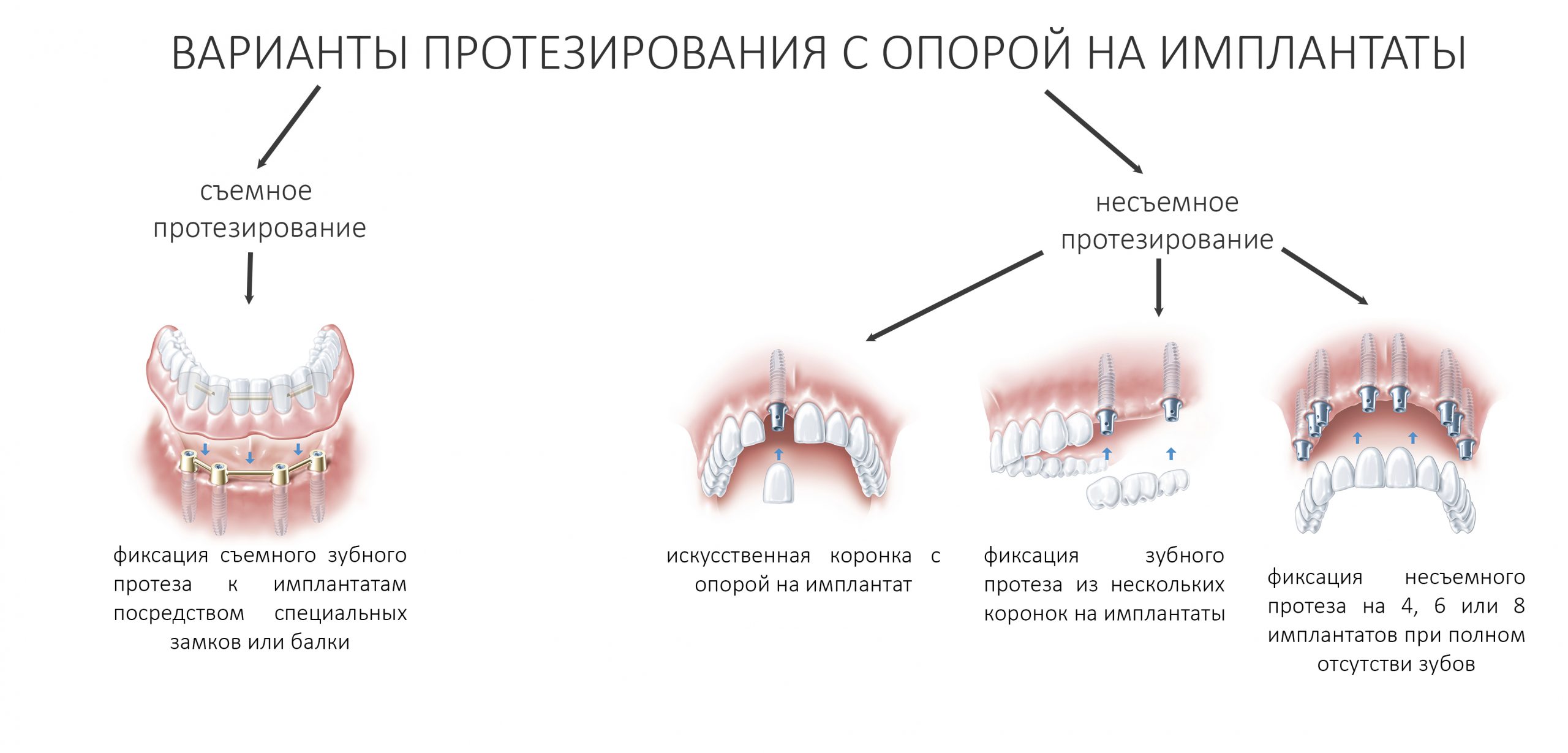 Как делается имплантация зубов на схеме покажите