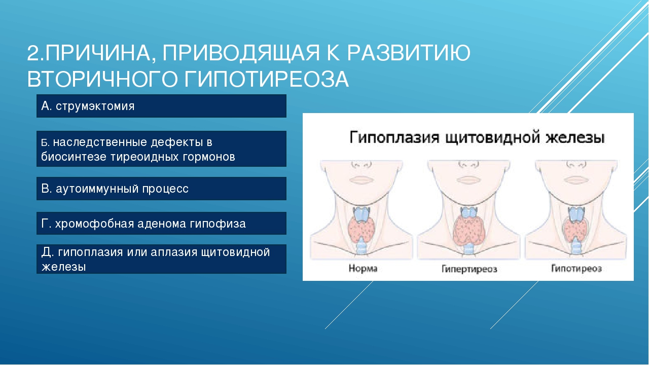 Гипотиреоз степени. Недоразвитие щитовидной железы. Гипоплазиязитовидной железы. Гипоплазия щитовидной железы у женщин.