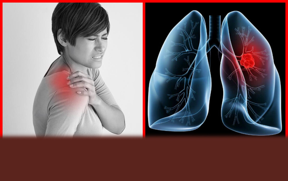 Рак лёгкого - симптомы болезни, профилактика и лечение рака лёгкого, причины заболевания и его диагностика на eurolab