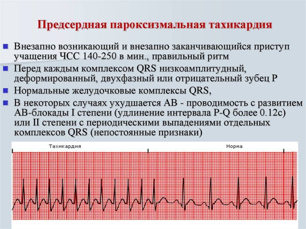 Впервые возникшая фибрилляция предсердий карта вызова