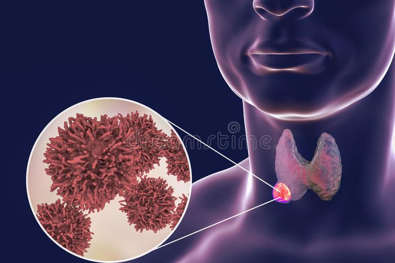 Рак щитовидной железы. симптомы, признаки, причины, диагностика и лечение заболевания.  :: polismed.com