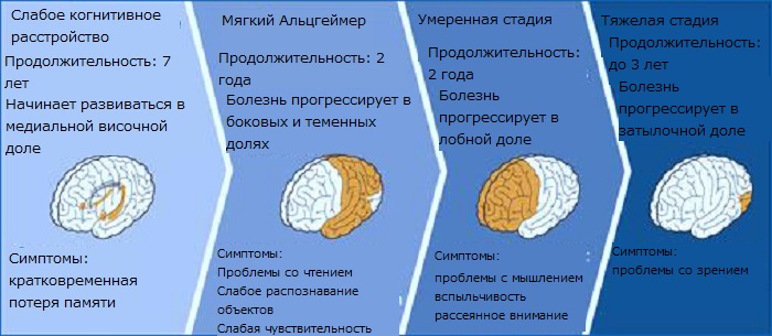 Умеренная атрофия мозга. Стадии развития болезни Альцгеймера. Этапы болезни Альцгеймера. Фазы болезни Альцгеймера. Деменция этапы болезни.