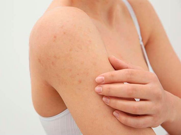 Британские врачи назвали ряд кожных симптомов «омикрона»