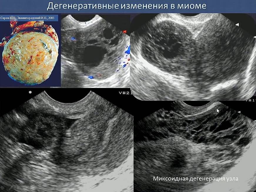 Эндометрия 21. Шеечный миоматозный узел. Некроз миоматозного узла на УЗИ.