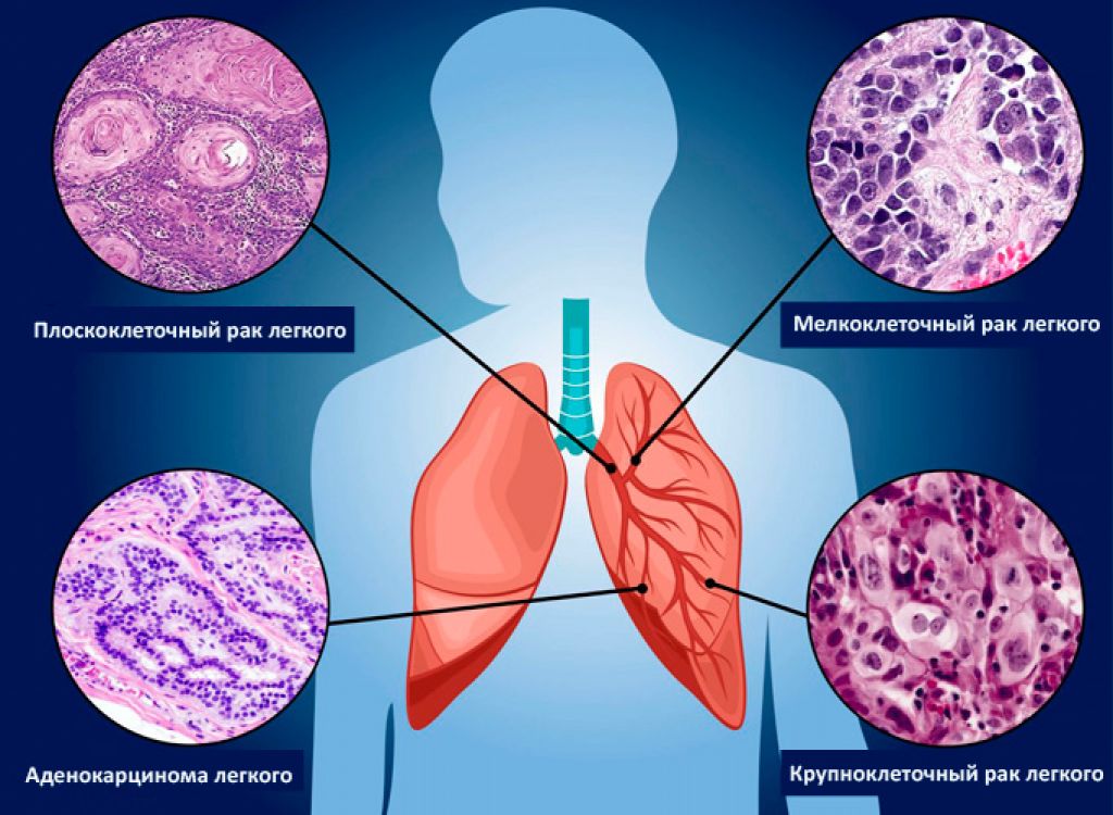 Стадии рака лёгких. информация для пациентов