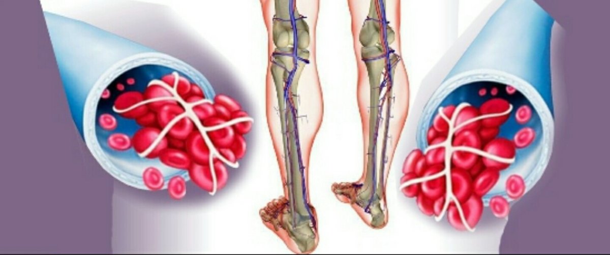 Тромбоэмболия артерий конечностей. Илеофеморальный венозный тромбоз. Тромбоз вен нижних конечностей. Тромбоз глубоких вен нижних конечностей этиология.