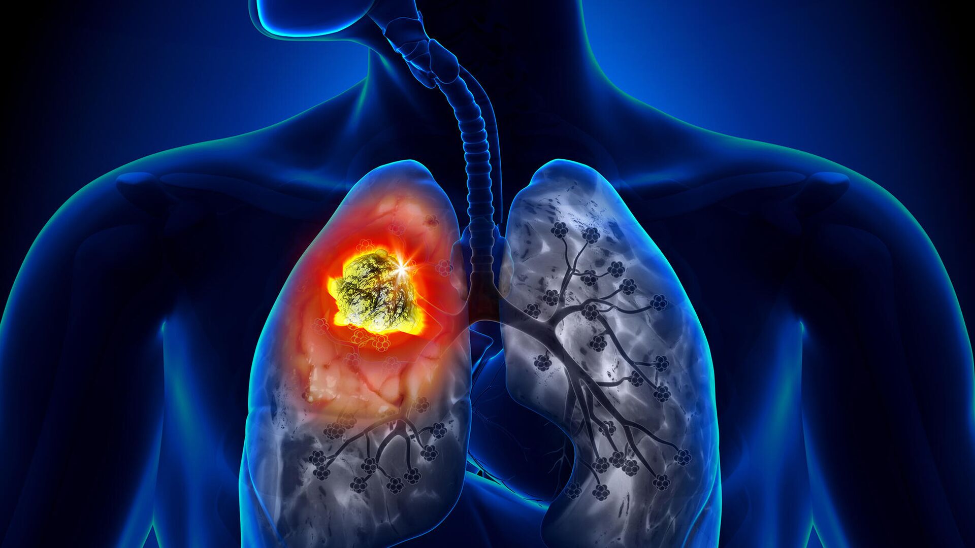 Рак легких: признаки и симптомы онкологии легких на первых стадиях у мужчин и женщин | клиники «евроонко»