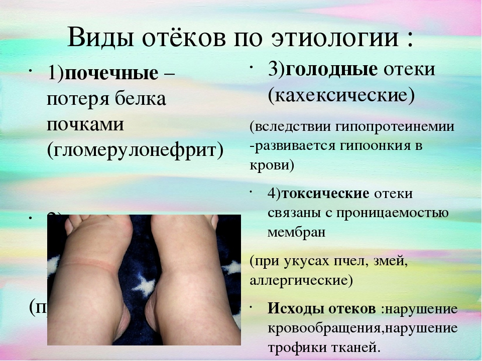 Когда отеки ног и лица — признак серьезной патологии * клиника диана в санкт-петербурге