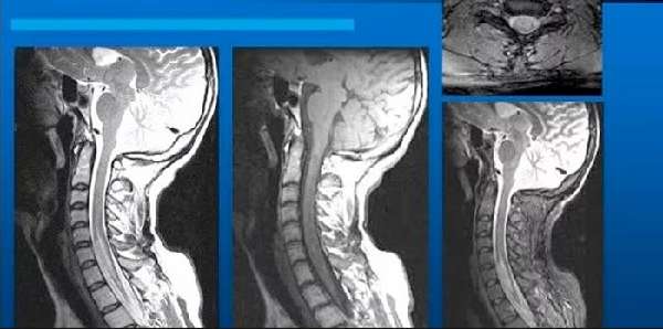 Инсульт спинного мозга на снимке