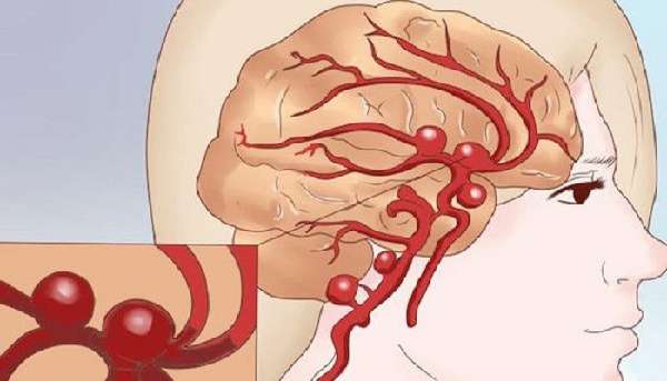 Субарахноидальное кровоизлияние в мозгу