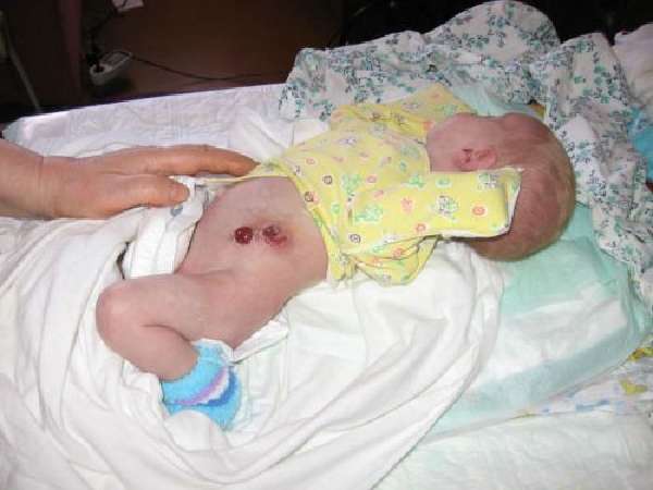 Ребенок с атрезией кишечника
