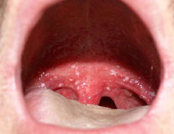 Дисбактериоз полости рта