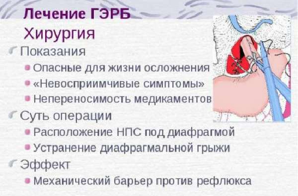 Хирургия ГЭРБ