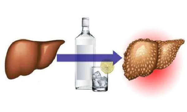 Влияние алкоголя на печень