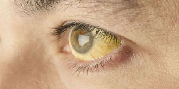 Желтые белки глаз