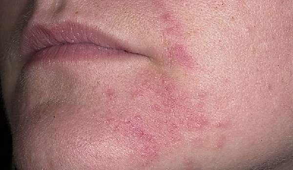 Аллергические высыпания на лице