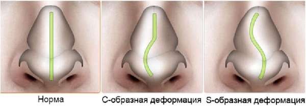 деформация носовой перегородки