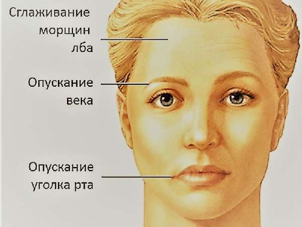 симптомы неврита лицевого нерва