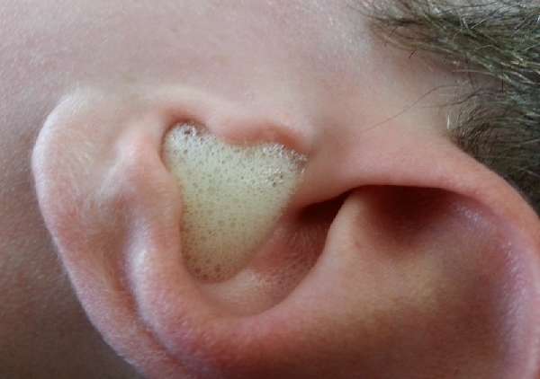 Перекись водорода в ушах