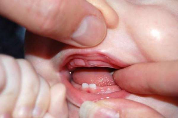 Первые зубы у ребенка