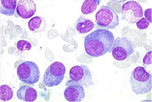Плазматические клетки в крови