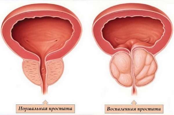 Простатит и нормальная простата