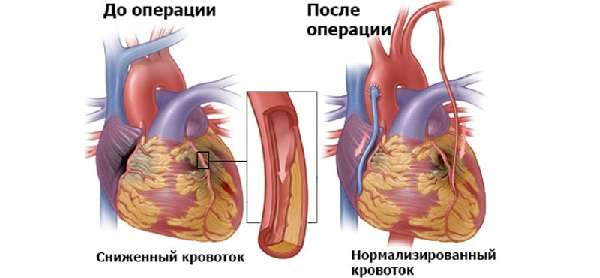 До и после шунтирования сердца