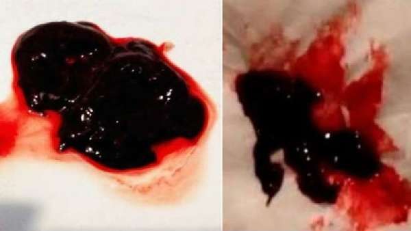 Сгустки крови во время менструации