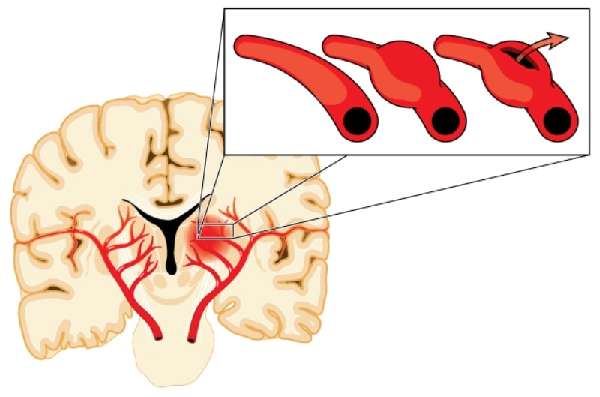 Спазм черепных артерий