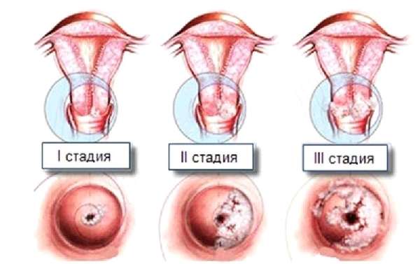 3 стадии дисплазии шейки матки