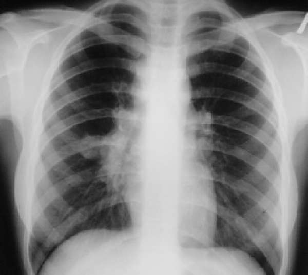 рентгенография при пневмонии
