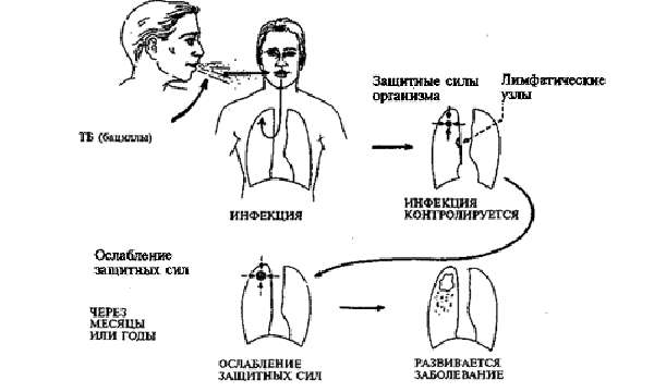 Виды туберкулезной инфекции