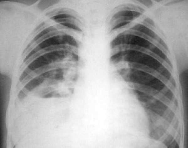 Рентгенологическая диагностика пневмоний