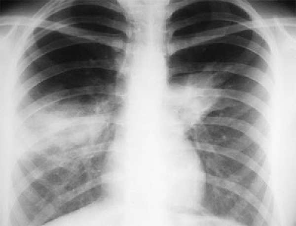рентгенологические признаки пневмонии