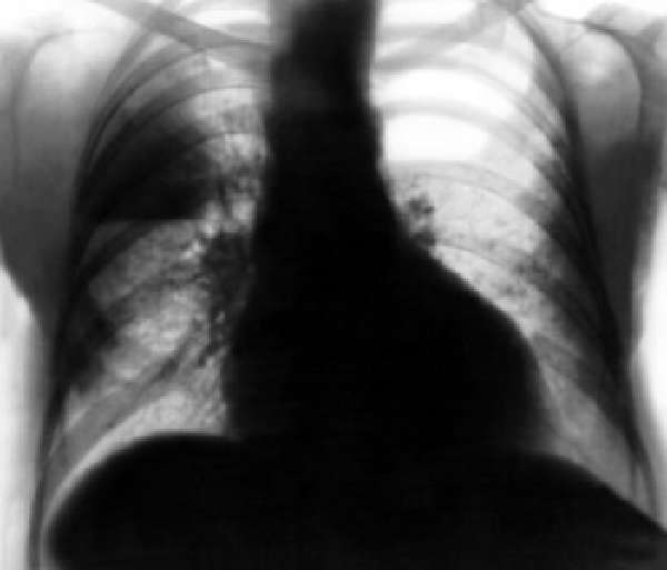 Верхнедолевая пневмония на рентгеновском снимке