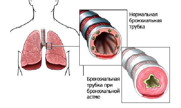 Особенности бронхиальной астмы