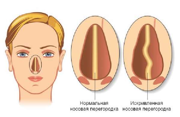 Исправление носовой перегородки операцией
