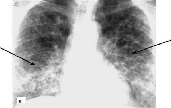 Двусторонняя нижнедолевая пневмония на рентгеновском снимке