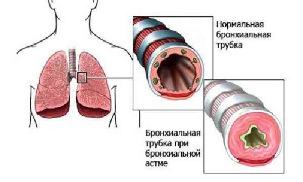 Схема бронхиальной астмы