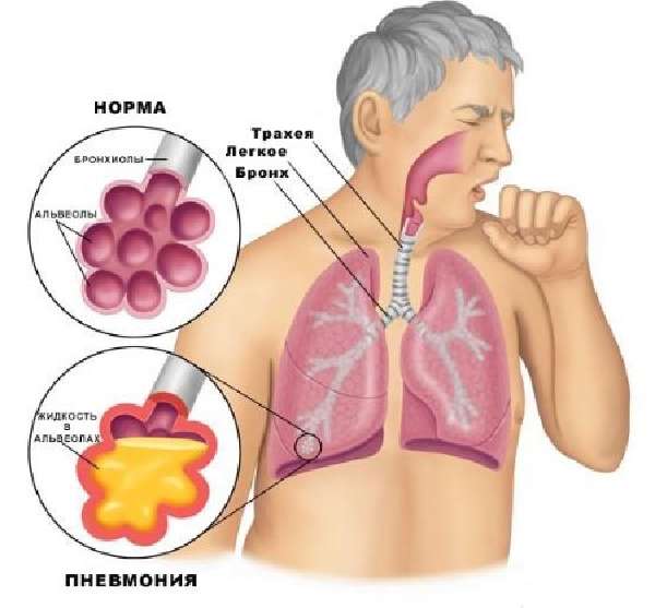 масляная пневмония