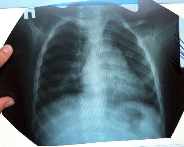 очаговая пневмония на рентгенограмме