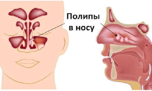Что такое полипоз носа?
