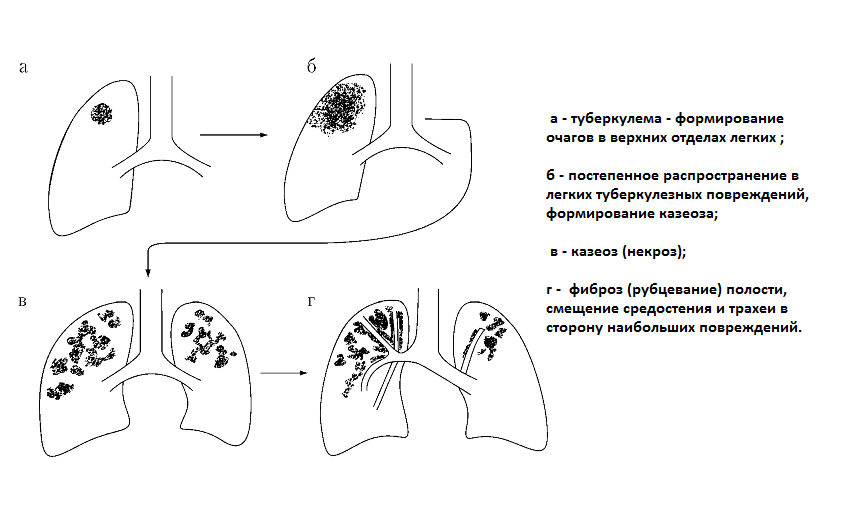 Типы распространения туберкуломы легких
