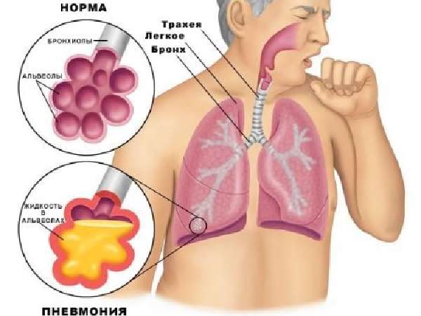жидкость в альвеолах при пневмонии