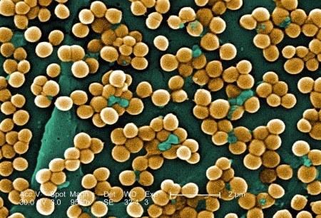 Золотистый стафилококк, возбудитель инфекционно-токсического шока при пневмонии