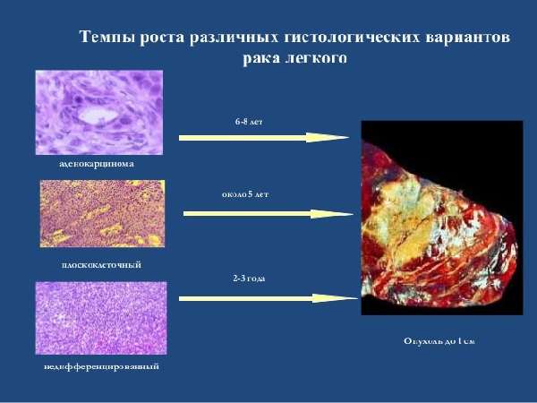 Виды плоскоклеточного рака